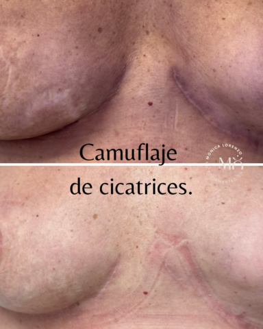 antes y después de camuflaje de cicatrices de pecho con micropigmentación por la especialista Mónica Lorenzo con sede en Gran Canaria y Madrid.