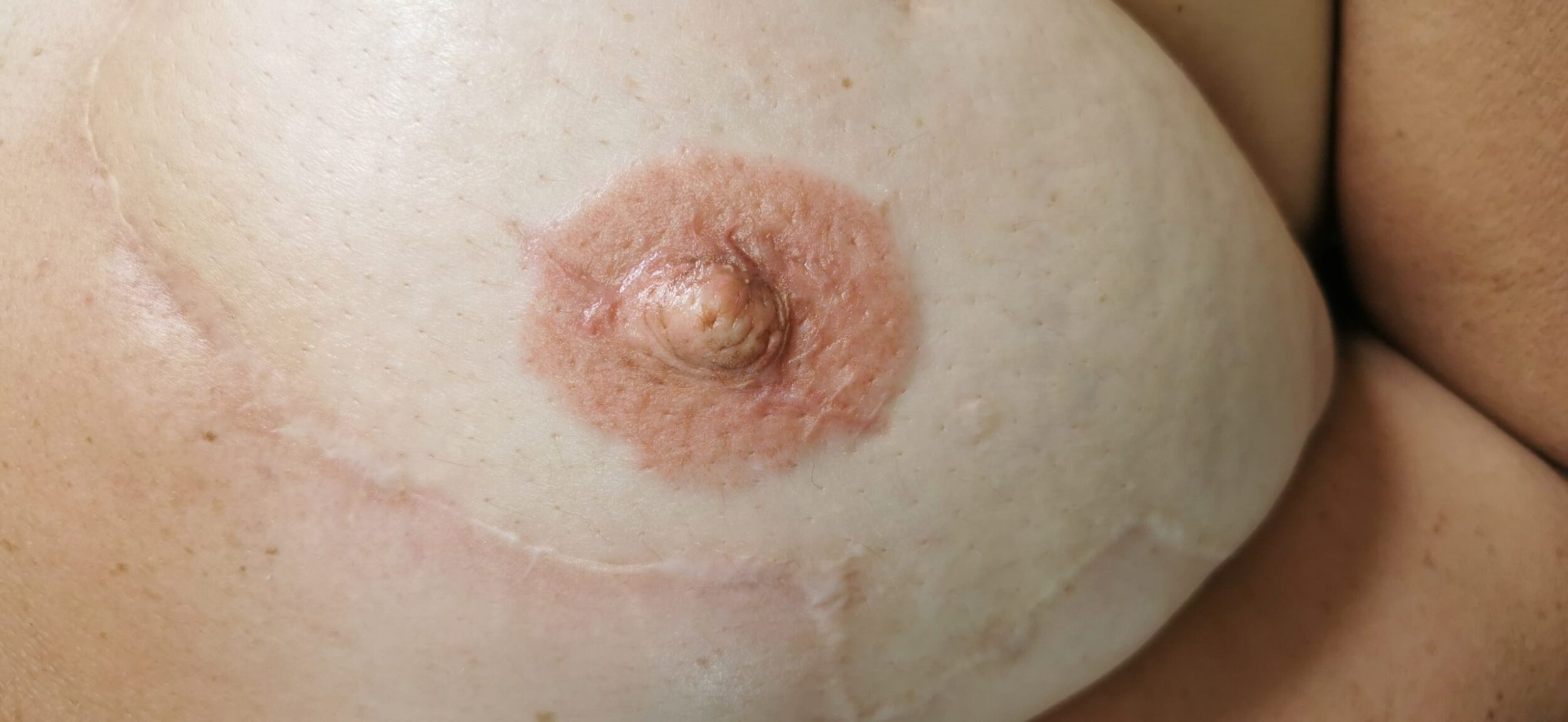 micropigmentacion de areola tras cancer de mama