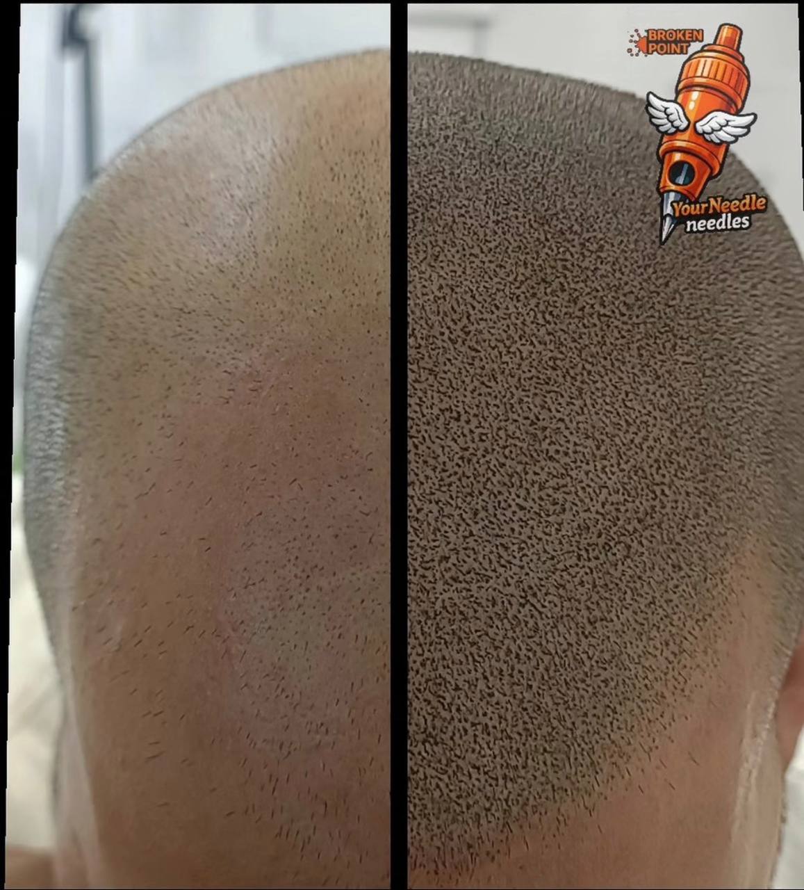 resultado micropigmentación capilar densidad antes y después