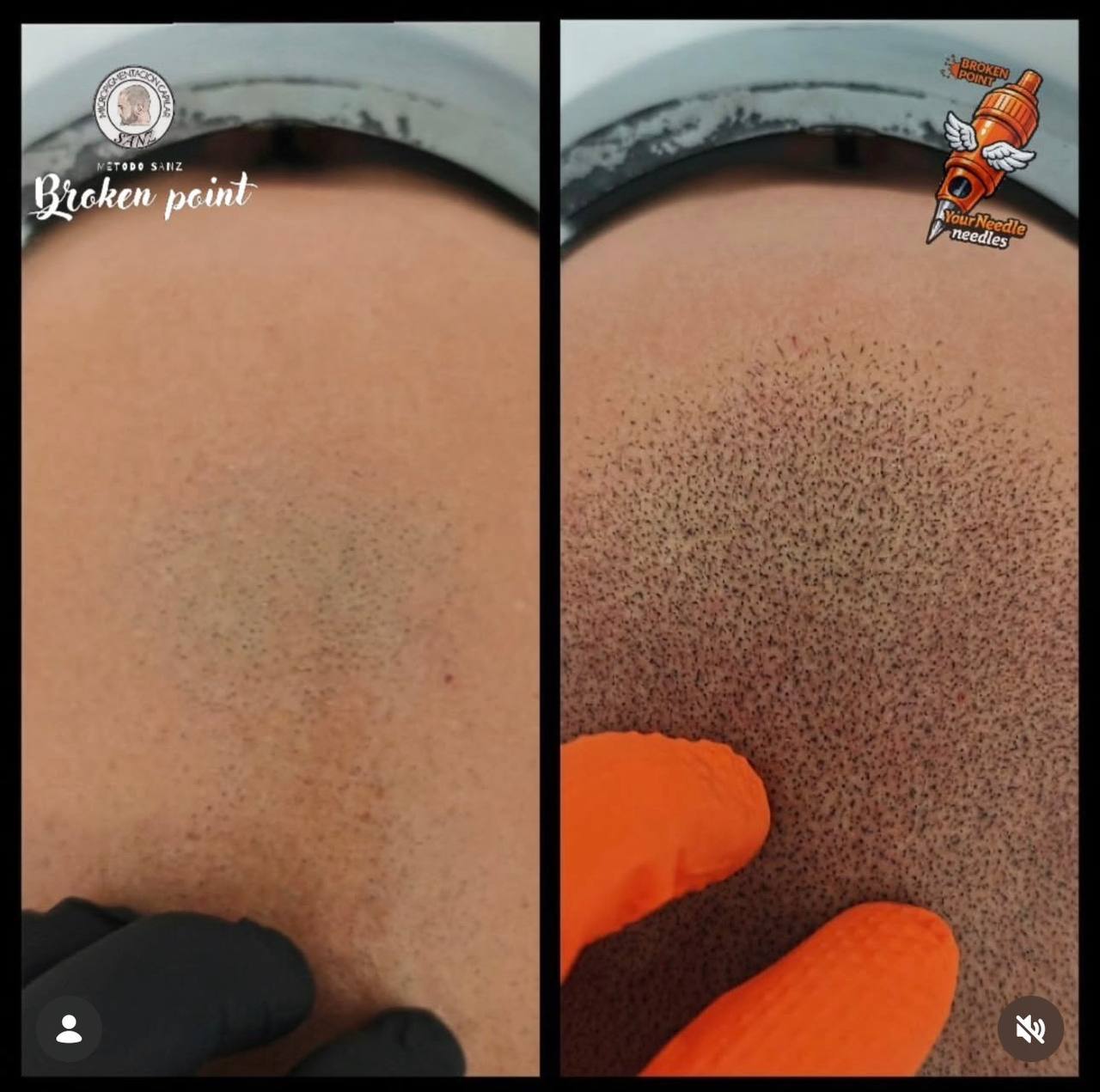micropigmentación capilar alopecia total Broken Point