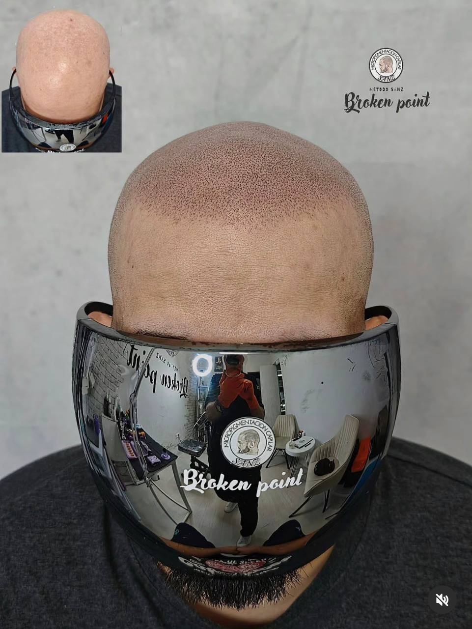 antes y después micropigmentación capilar técnica Broken Point