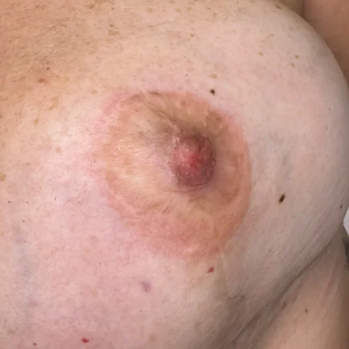 micropigmentacion-areolas (1)