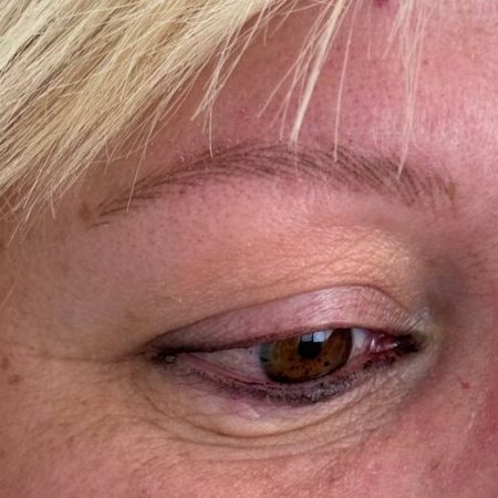 cejas sombreadas en alopecia frontal fibrosante Canarias y Madrid
