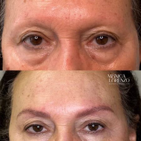 micropigmentacion cejas pelo a pelo en caso de alopecia frontal en canarias
