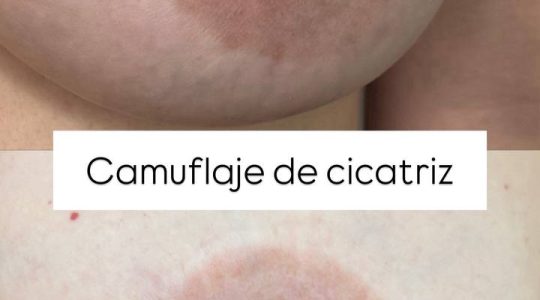 antes y después de camuflaje de cicatriz alrededor de la areola en Madrid