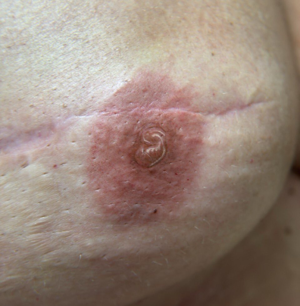 micropigmentacion-de-areolas-recien-realizado-por-Monica-Lorenzo