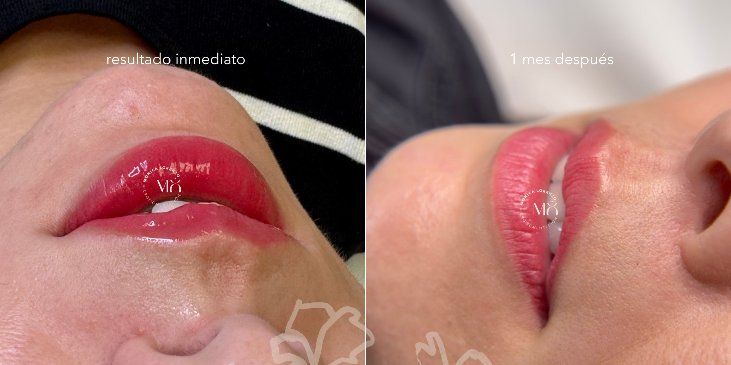 se puede besar después de la micropigmentación de labios