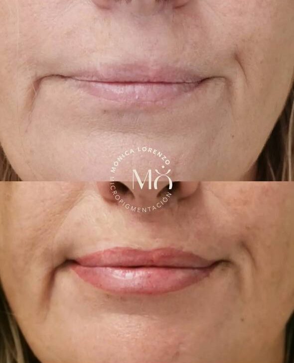 micropigmentacion reparadora de labios, una técnica poco conocida en España y una gran solución tras cirugías de labio.