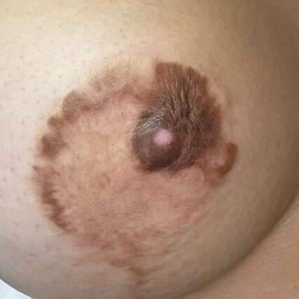 areola con cicatriz