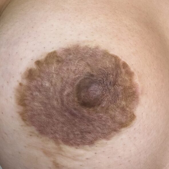 camuflaje cicatriz areola