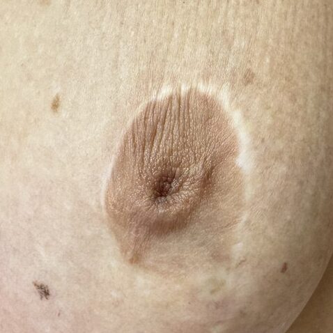 cicatriz periareolar blanquecina tras cirugía de reducción de mama.