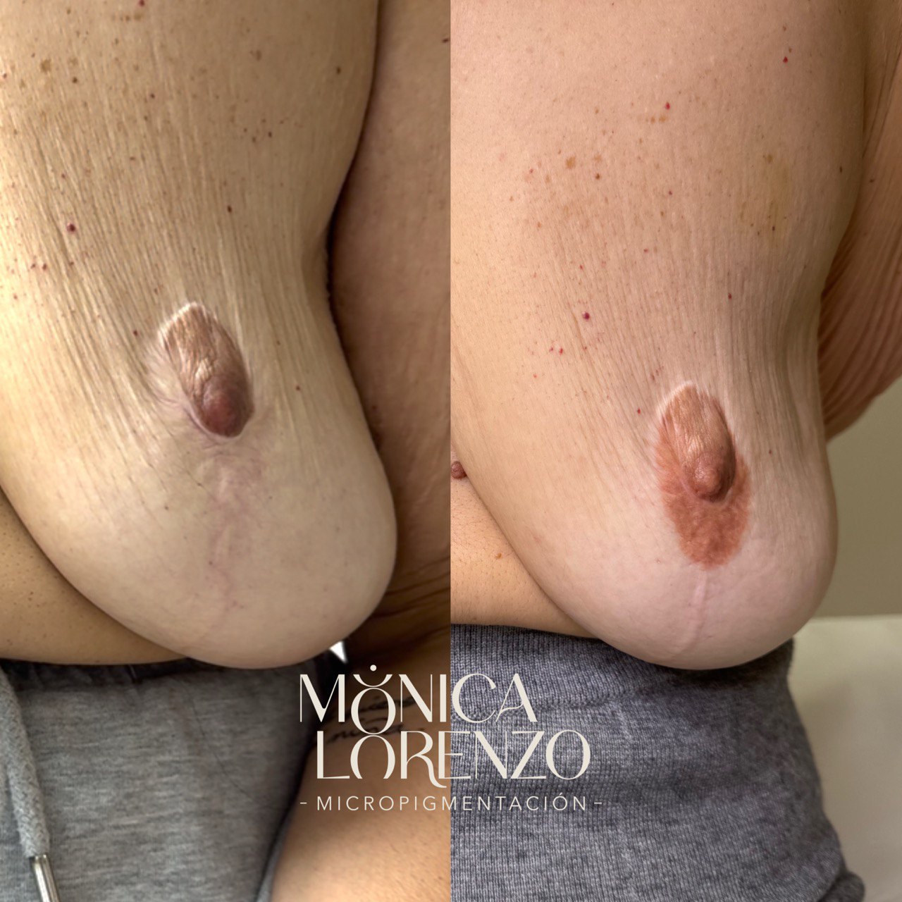 corrección cicatriz areola
