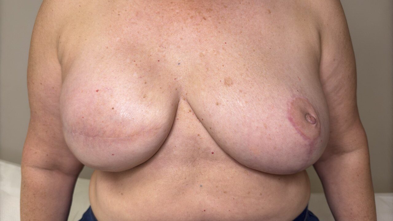micropigmentacion de areola tras cancer de mama con efecto 3D