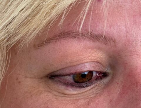 cejas sombreadas en alopecia frontal fibrosante Canarias y Madrid