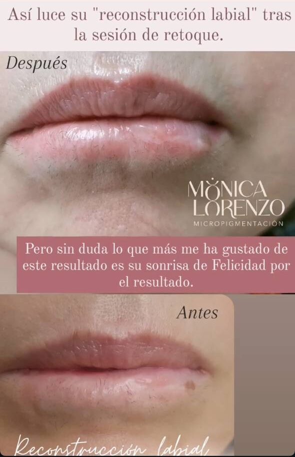 reconstruccion-de-labio-con-micropigmentacion